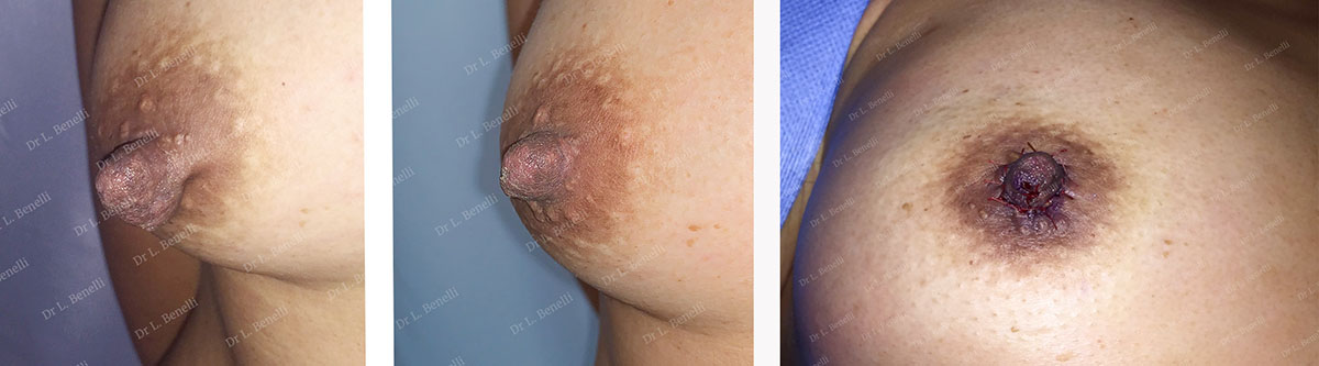 Photo avant / après de réduction des mamelons par le Dr Louis Benelli chirurgien esthétique