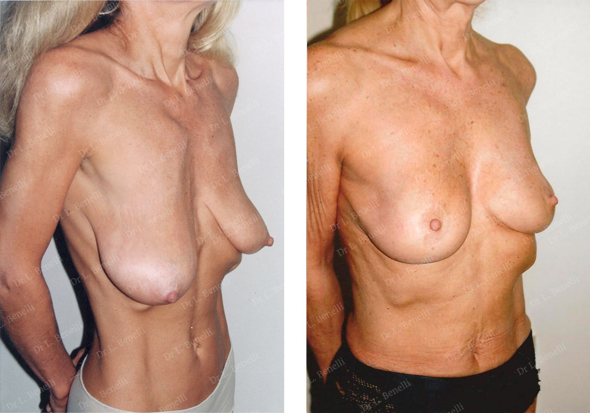 Photo before and after a breast lift performed by Dr. Benelli, plastic surgeon