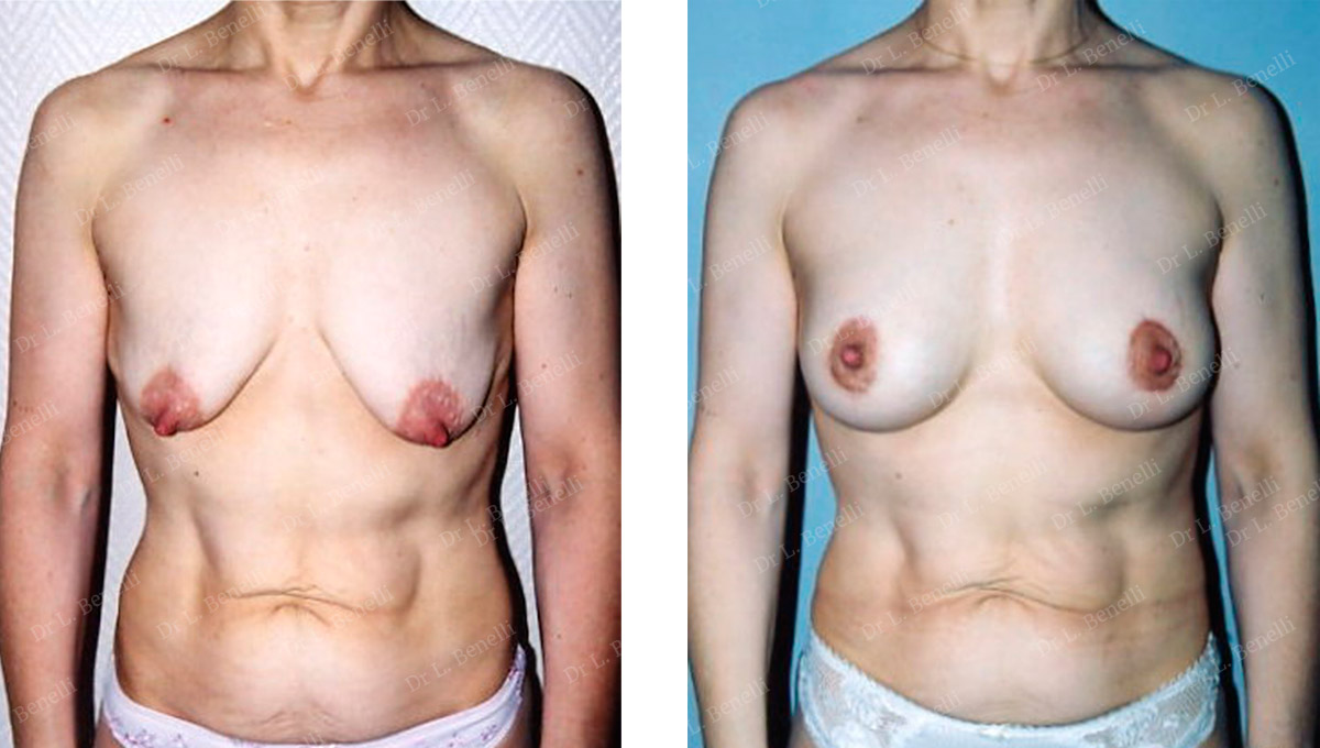 Photo before and after a breast lift performed by Dr. Benelli, plastic surgeon