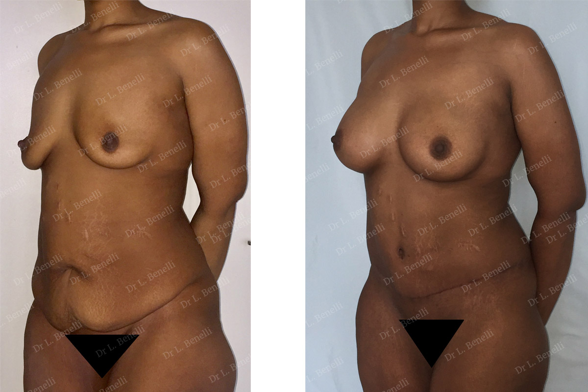 Photo before and after a breast lift performed by Dr. Benelli, plastic surgeon