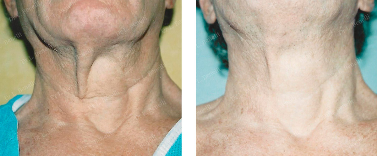Photo before and after a Curl-lift by Dr. Benelli, plastic surgeon