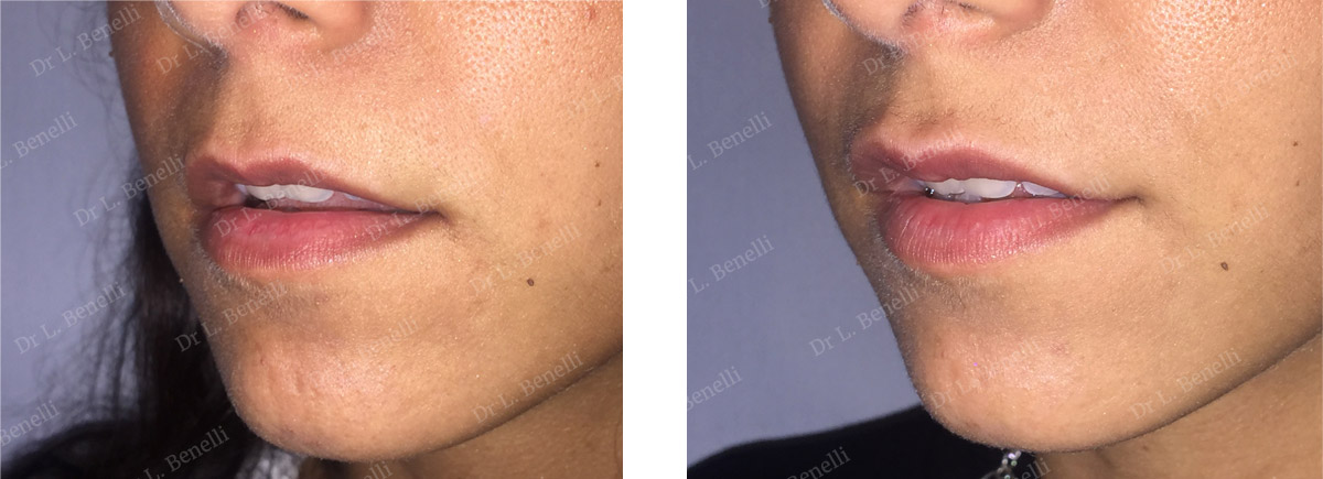 Photo before and after aesthetic lip treatment by Dr. Benelli, plastic surgeon