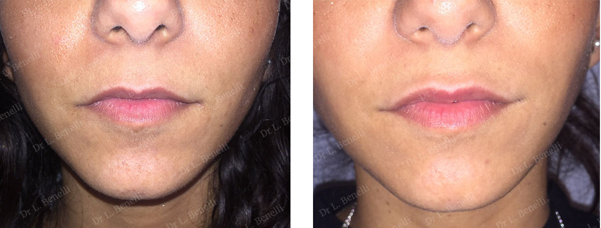 Photo before and after aesthetic lip treatment by Dr. Benelli, plastic surgeon