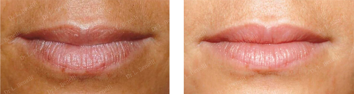 Photo before and after aesthetic lip treatment by Dr. Benelli, plastic surgeon