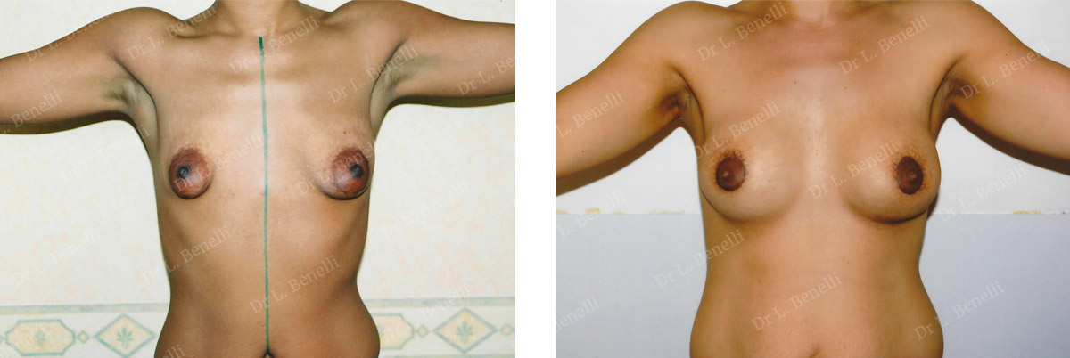 Photo before and after areola reduction by Dr. Benelli, plastic surgeon