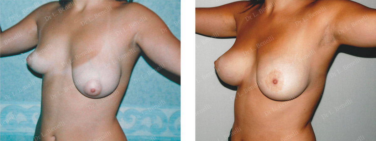 Photo before and after asymmetric breast correction by Dr. Benelli, plastic surgeon