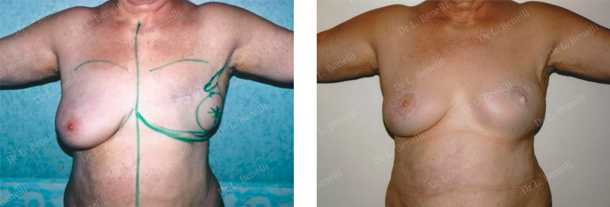 Photo before and after breast reconstruction by Dr. Benelli, plastic surgeon