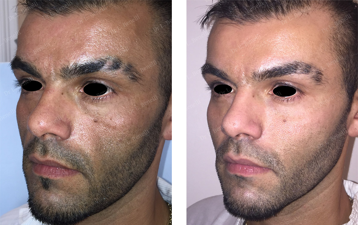 Photo before and after eyelid surgery on a man by Dr. Benelli, plastic surgeon