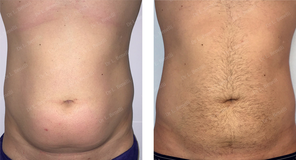 Photo before and after liposuction on a male patient by Dr. Benelli, plastic surgeon