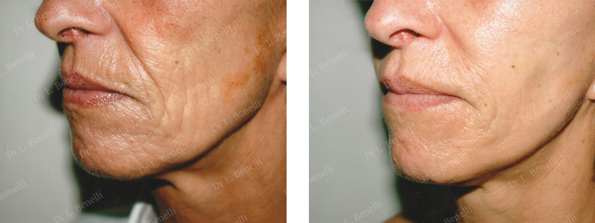 Photo before and after peeling by Dr. Benelli, plastic surgeon