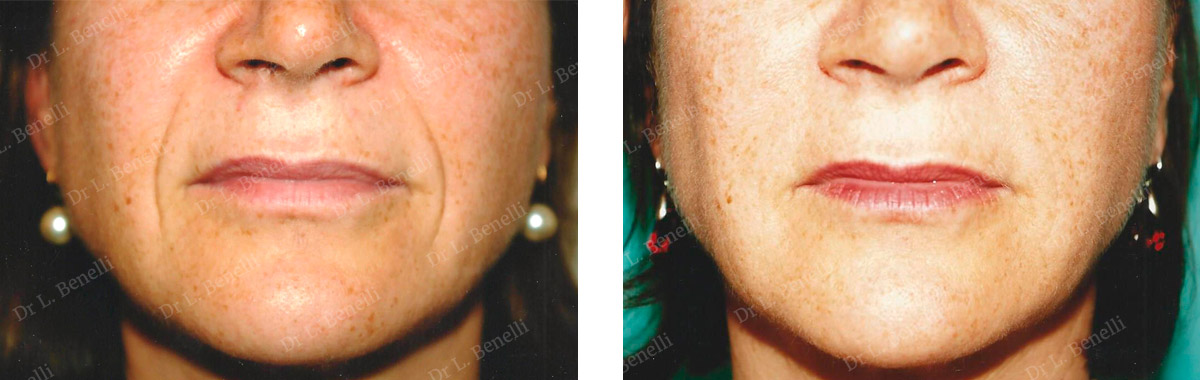 Photo before wrinkle treatment using injections, carried out by Dr. Louis Benelli