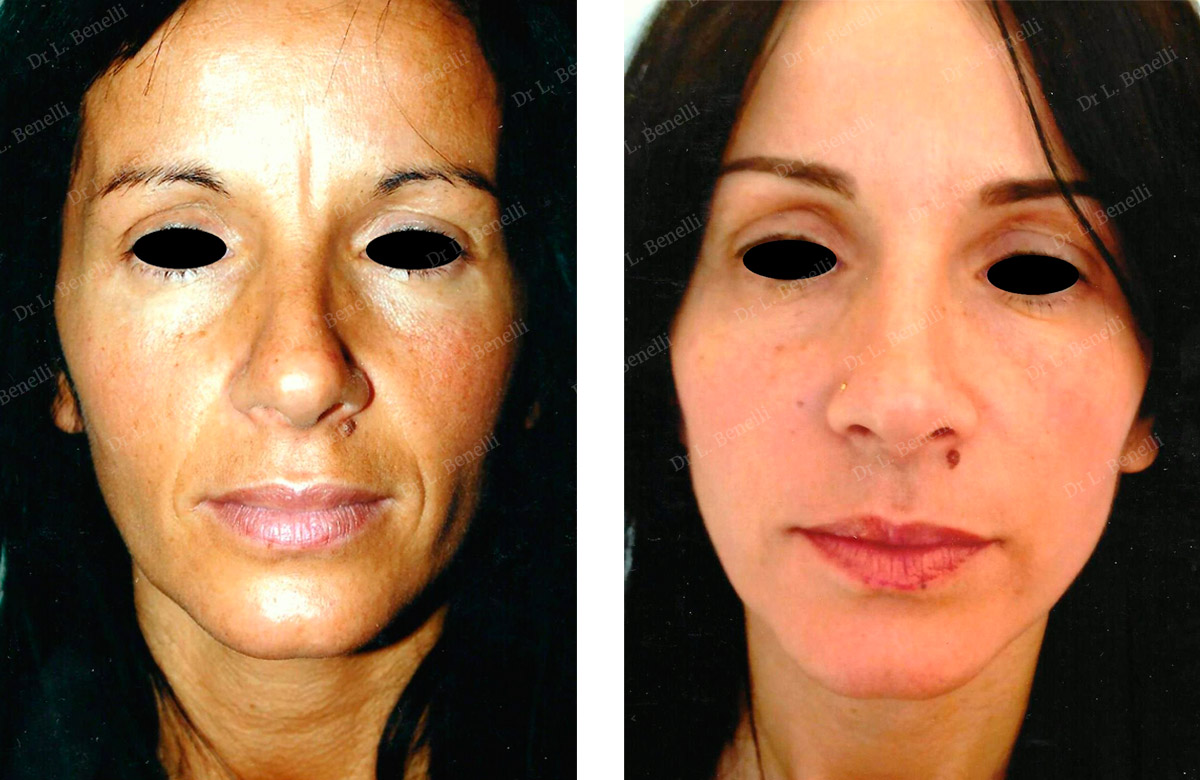 Photo before wrinkle treatment using injections, carried out by Dr. Louis Benelli