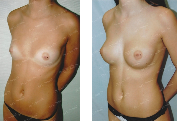 Photo breast augmentation performed by Dr. Louis Benelli, plastic surgeon
