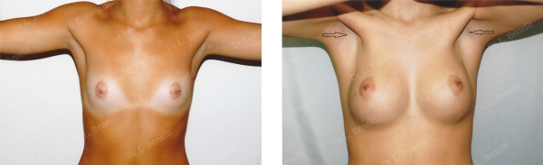 Photo breast augmentation performed by Dr. Louis Benelli, plastic surgeon
