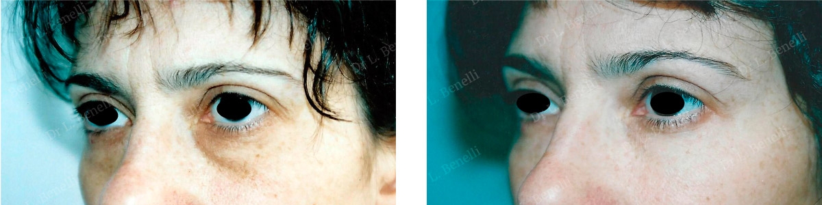 Photo de blépharoplastie inférieure réalisé par le Dr Louis Benelli chirurgien esthétique