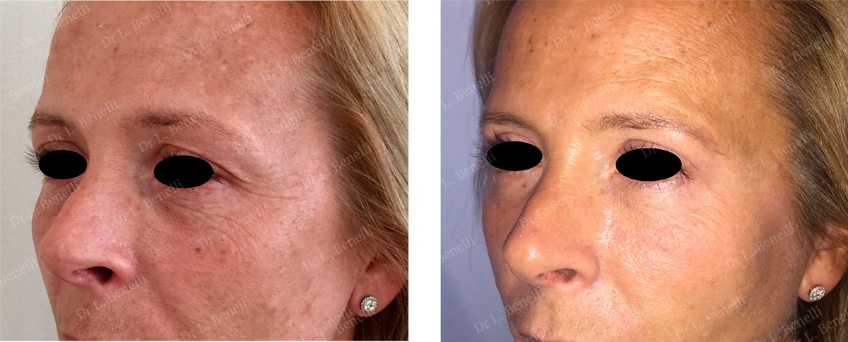 Photo de blépharoplastie supérieure réalisé par le Dr Louis Benelli chirurgien esthétique