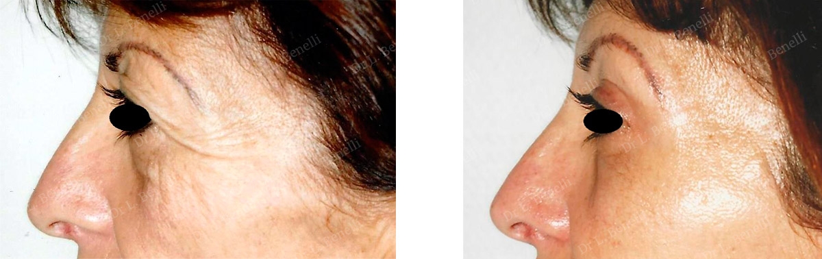 Photo de blépharoplastie supérieure réalisé par le Dr Louis Benelli chirurgien esthétique