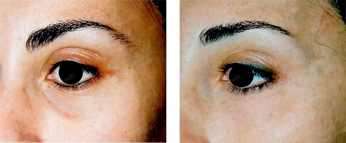 Photo de blépharoplastie supérieure réalisé par le Dr Louis Benelli chirurgien esthétique