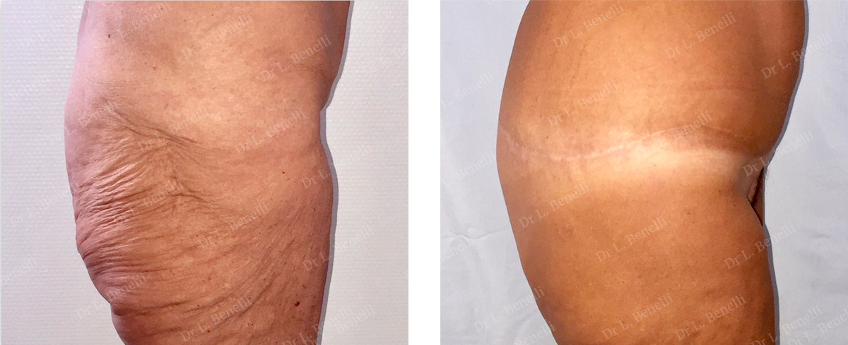 Photo de bodylift ru00e9alisu00e9e par le Dr Louis Benelli chirurgien esthu00e9tique