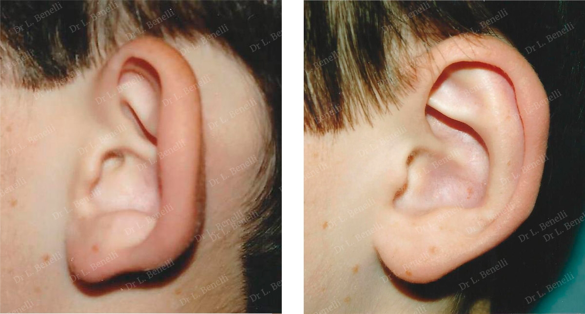 Photo de chirurgie des oreilles décollées réalisé par le Dr Louis Benelli chirurgien esthétique