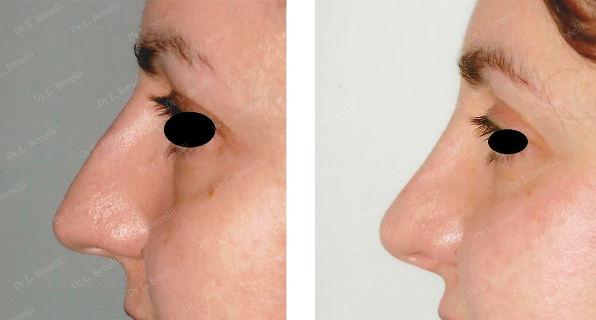 Photo de rhinoplastie réalisée par le Dr Louis Benelli chirurgien esthétique