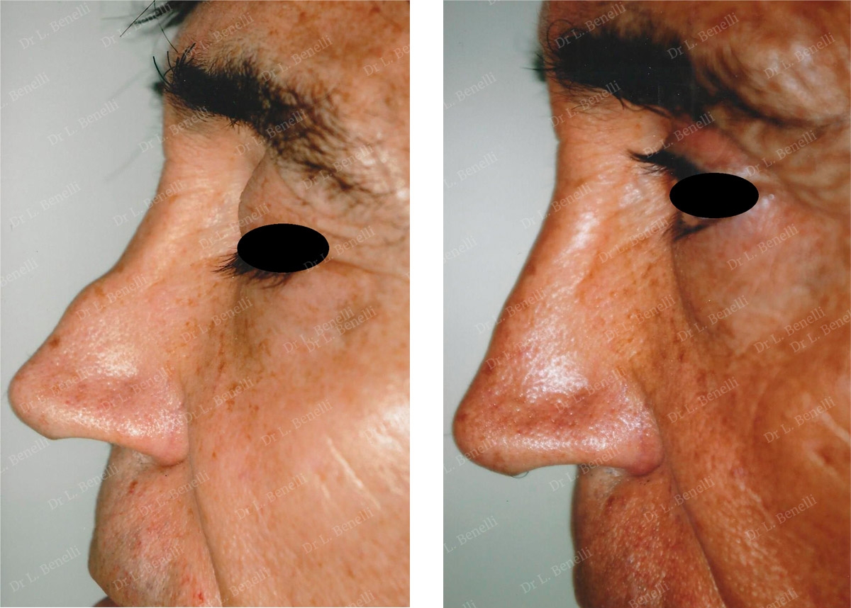 Photo de rhinoplastie réalisée par le Dr Louis Benelli chirurgien esthétique