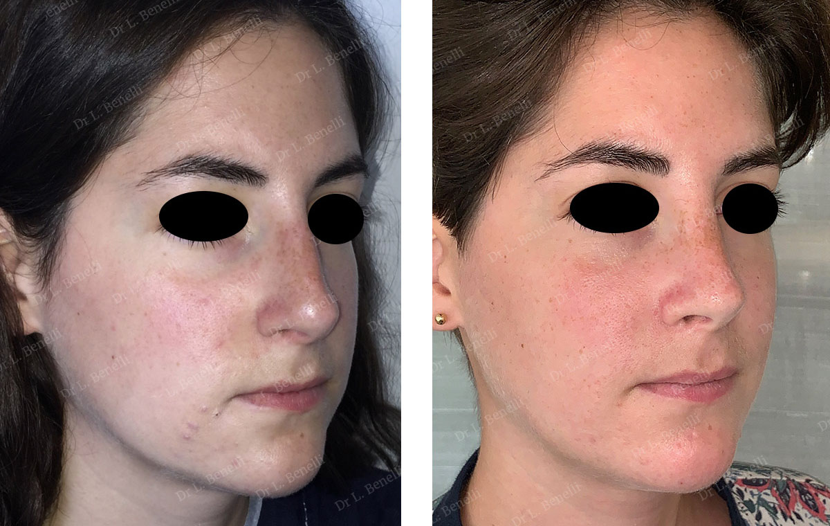 Photo de rhinoplastie réalisée par le Dr Louis Benelli chirurgien esthétique