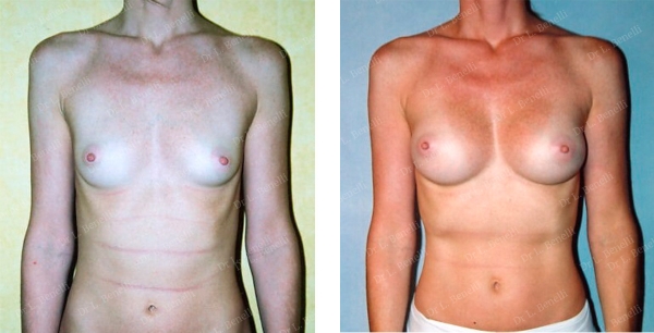 Photo of a breast augmentation performed by Dr. Louis Benelli, plastic surgeon