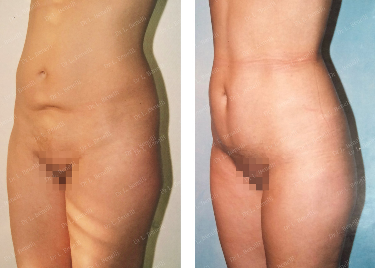 Photo of abdominal plastic surgery carried out by Dr Louis Benelli, plastic surgeon