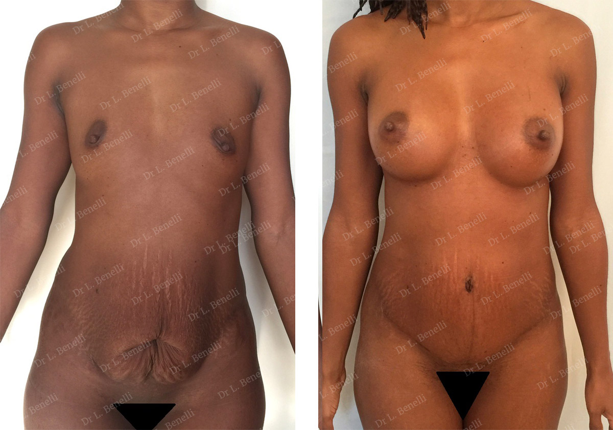 Photo of abdominal plastic surgery taken by Dr Louis Benelli, plastic surgeon