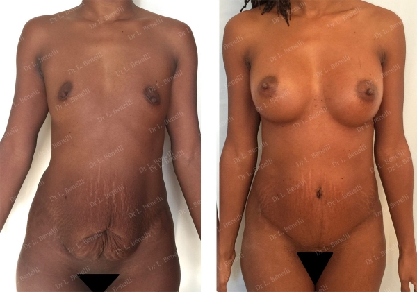 Photo of abdominoplasty performed by Dr Louis Benelli plastic surgeon