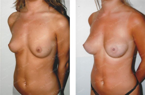 Photo of breast augmentation performed by Dr. Louis Benelli, plastic surgeon