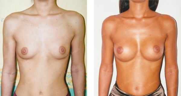 Photo of breast augmentation performed by Dr. Louis Benelli plastic surgeon
