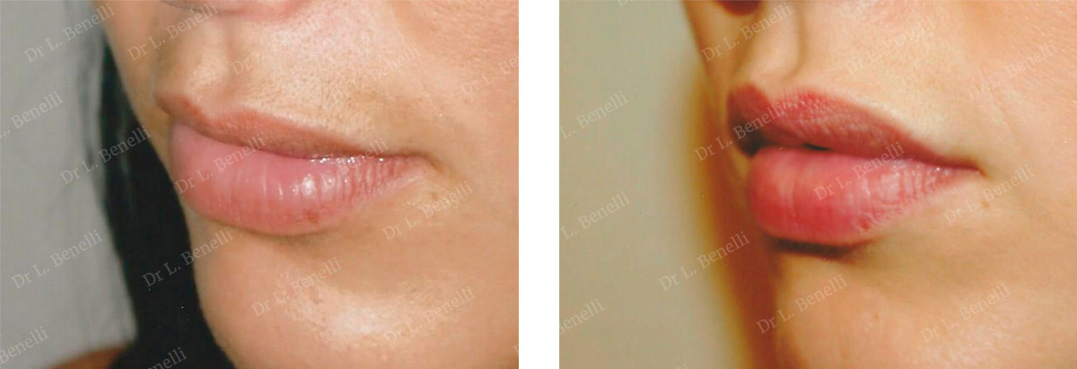 Photo of lip surgery performed by Dr. Louis Benelli, plastic surgeon
