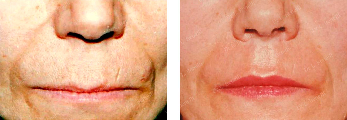 Photo of lip surgery performed by Dr. Louis Benelli, plastic surgeon
