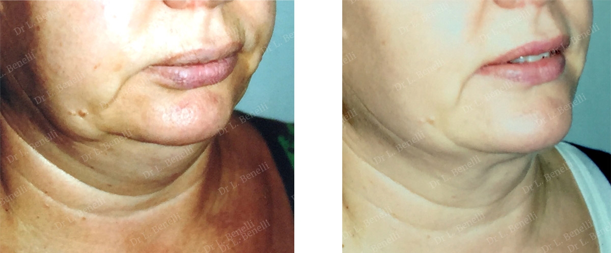 Photo of lipomodelling by Dr Louis Benelli, plastic surgeon