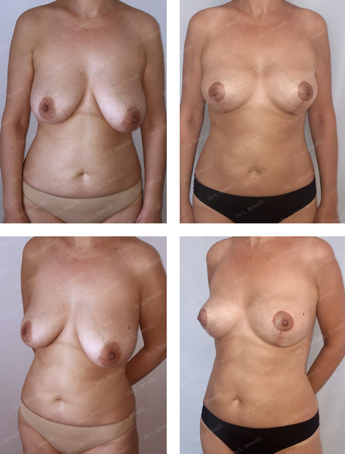 Réduction et symétrisation mammaire avant après réalisée par le Dr Benelli chirurgien plasticien