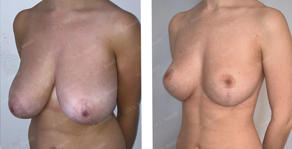 Réduction mammaire sans cicatrice sous le sein réalisée par le Dr Benelli
