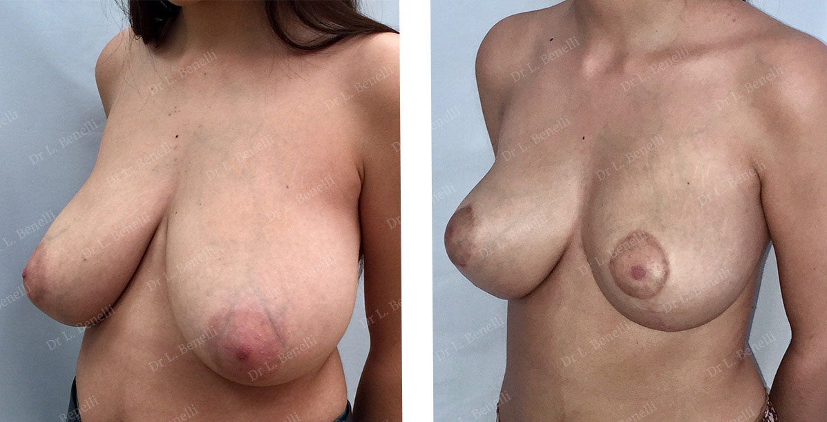 Réduction mammaire sans cicatrice sous le sein réalisée par le Dr Benelli