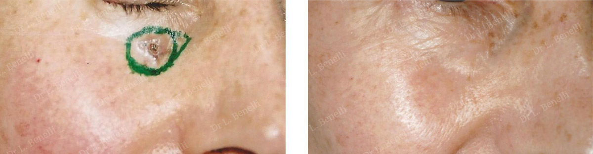 Removal of a malignant skin tumour by Dr Benelli, a surgeon in Paris