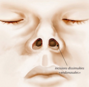 Rhinoplasty operating diagram