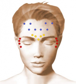 Schéma des points d'injection de Botox