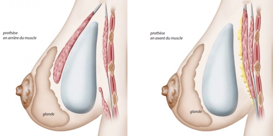 Schéma du positionnement des prothèses mammaires en avant ou en arrière du muscle