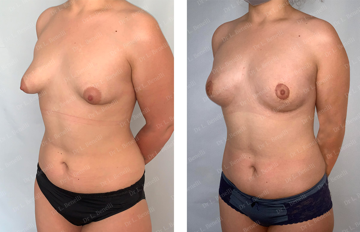 Photo avant / après de seins tubéreux réalisé par le Dr Louis Benelli chirurgien esthétique