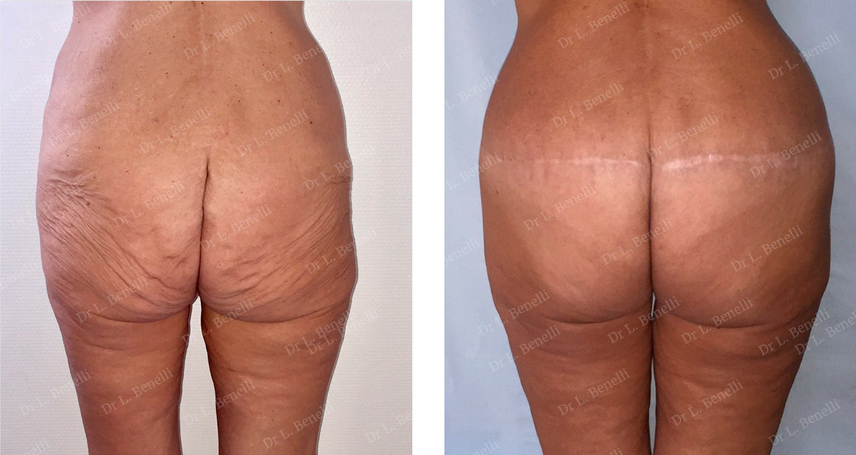Thigh lift with inguinal scar and posterior body lift performed by Dr Louis Benelli, plastic surgeon