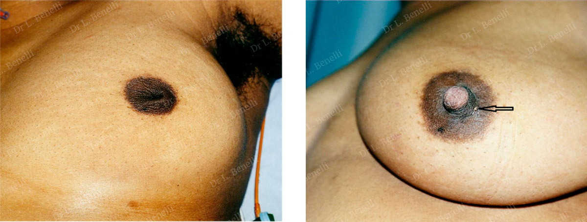 Treatment of inverted nipples by Dr. Benelli, plastic surgeon