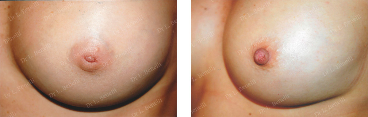 Treatment of inverted nipples by Dr. Benelli, plastic surgeon