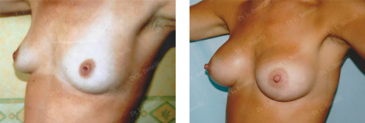 Treatment of inverted nipples by Dr. Benelli, plastic surgeon