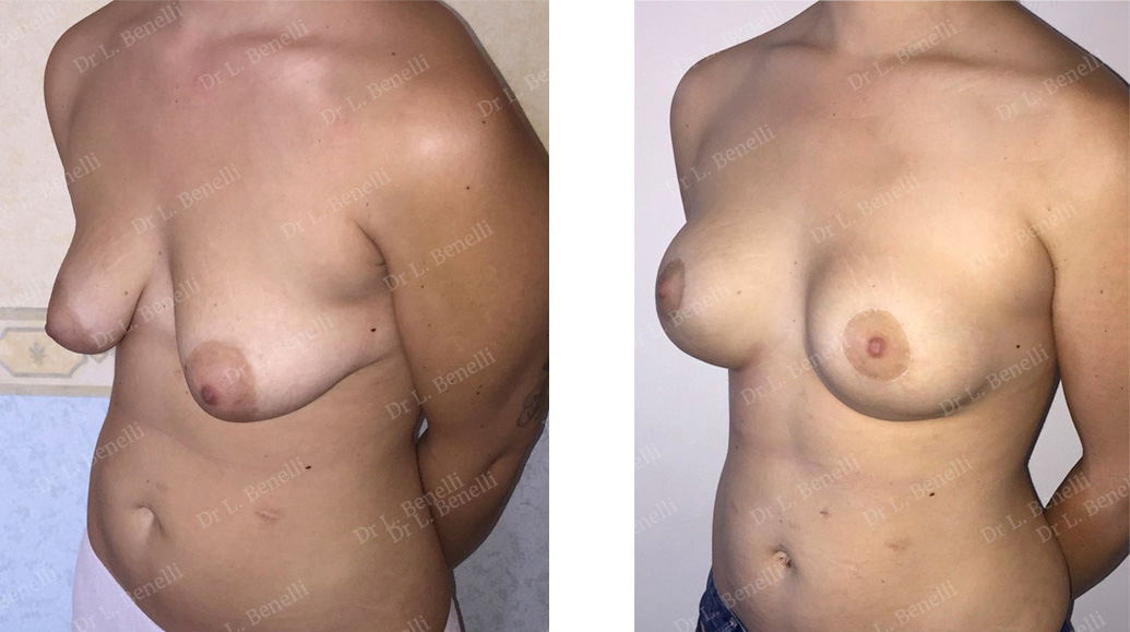 Tuberous breast treatment performed by Dr. Louis Benelli, plastic surgeon