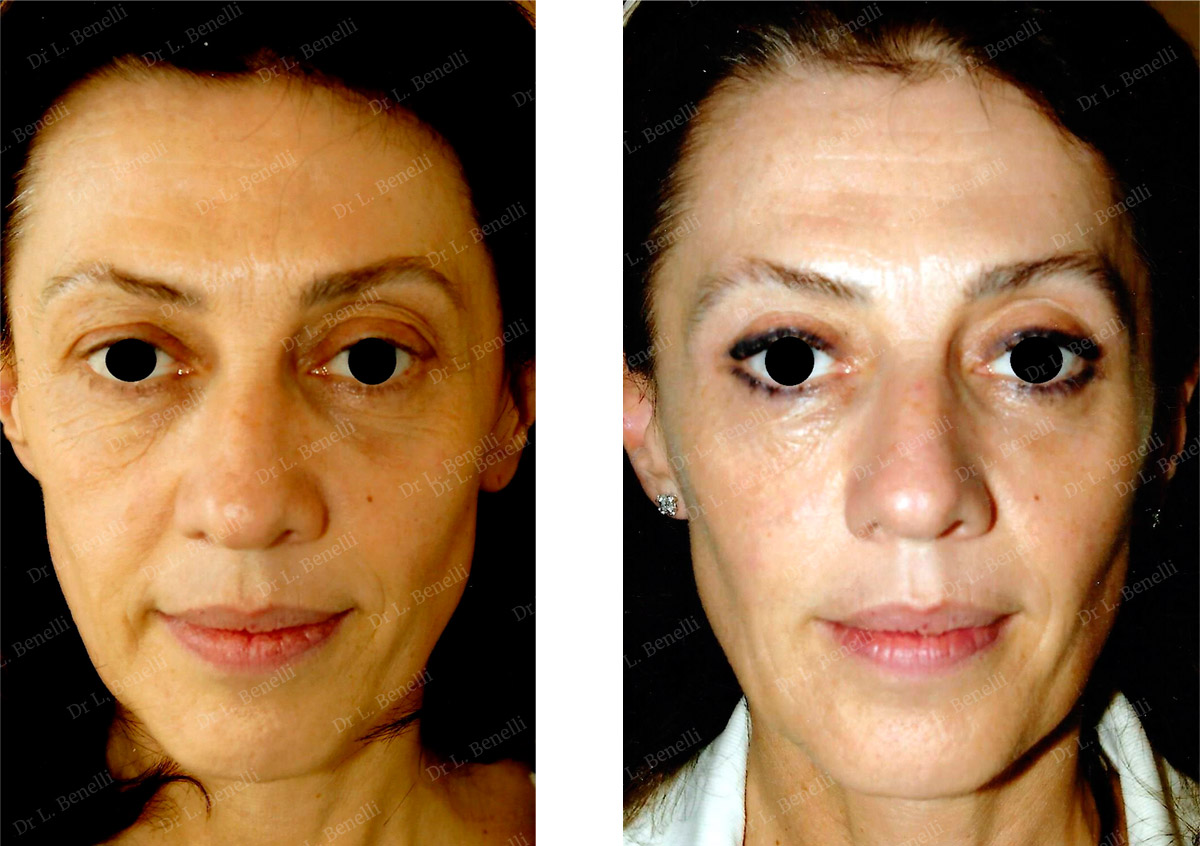 Upper blepharoplasty photo taken by Dr Louis Benelli, plastic surgeon